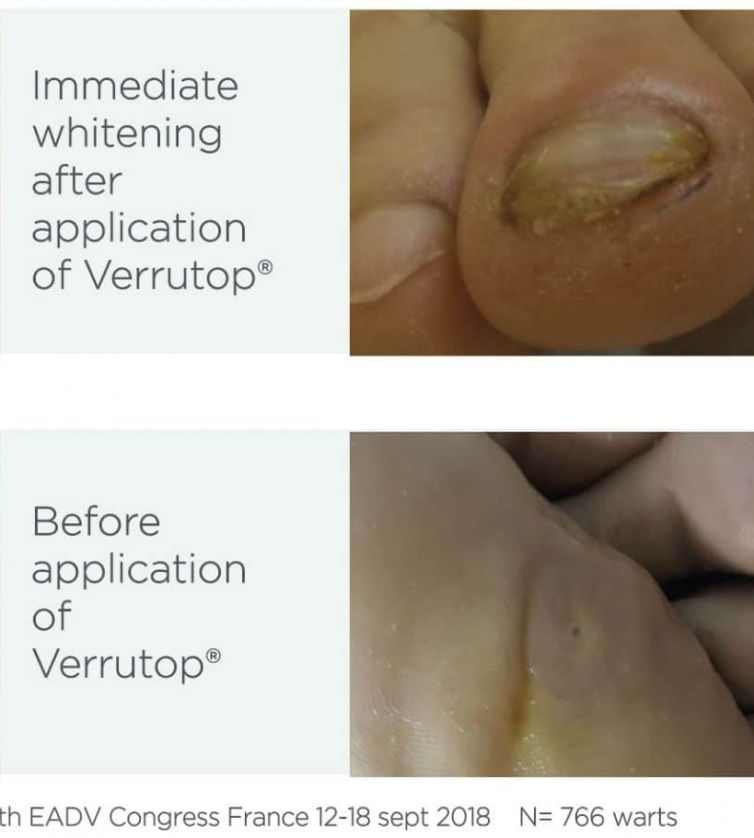 Verrutop Wart and Verruca Treatment