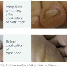Verrutop Wart and Verruca Treatment