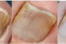 Dermatonics Nail Recovery Gel 10ml – 20% Urea
